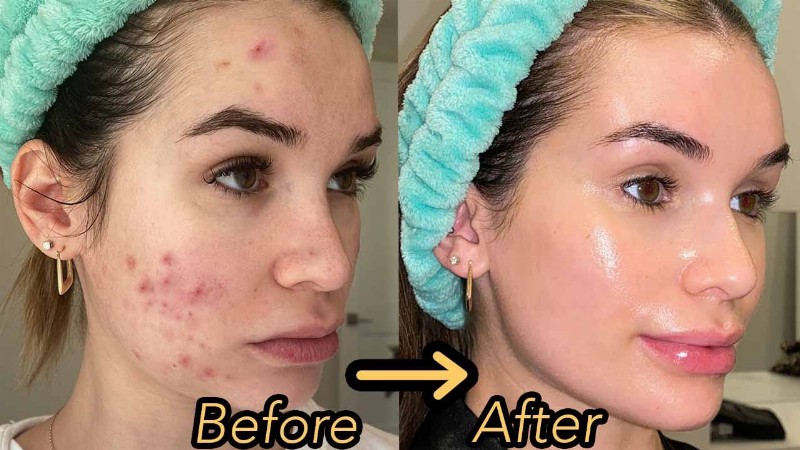 How I Finally Cleared My Acne And Textured Skin! *hormonal Acne Skincare Routine*